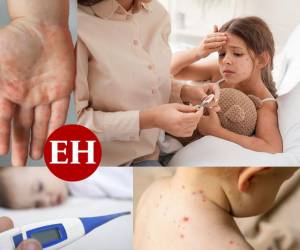 Cuando creíamos que nos habíamos adaptado al covid-19, llega la viruela del mono, una enfermedad que se esparció rápidamente por el mundo y aunque la mayoría de casos se reportan en adultos, los niños no están exentos de contraerla. Por eso, es importante saber ante qué síntomas se debe estar atentos para poder diferenciarlos de otras enfermedades como la varicela. Aquí te contamos de cuáles se trata. ¡Toma nota!