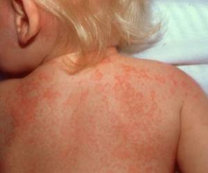 Además de la fiebre intensa que puede durar hasta dos semanas, erupcion en el abdomen, pecho y genitales, enrojecimiento de ojos, los labios se ponen rojos, secos y agrietados, son algunos de lo síntomas.