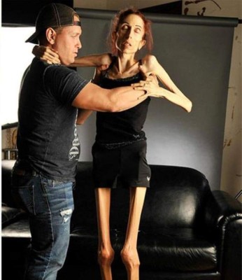 Así luce hoy Rachael Farrokh la mujer que pidió ayuda para superar su anorexia