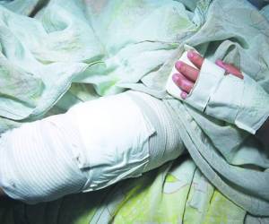 La mayoría de las personas afectadas por pólvora han salido lesionados de su dedo medio de la mano derecha.