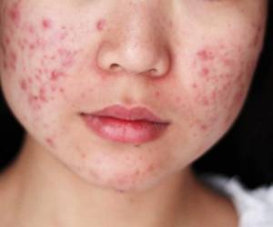Existen diferentes tipos de acné y para saberlo lo recomendable es acudir con un especialista.