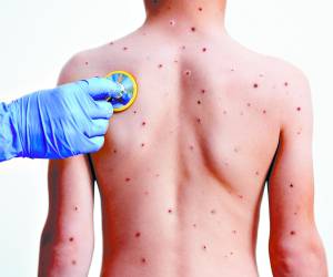 El primer caso de viruela del mono en Honduras se confirmó el pasado 12 de agosto.