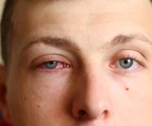 Los síntomas de la enfermedad son: resequedad, ardor, y picazon, en los ojos, asimismo la persona sufre un enrojecimiento de los ojos. Foto: Cortesía.