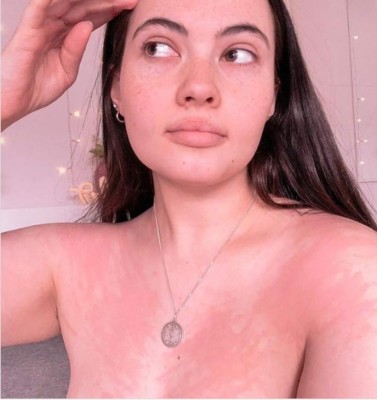 Tessa Hansen-Smith, la mujer alérgica al agua, a sus lágrimas y su sudor