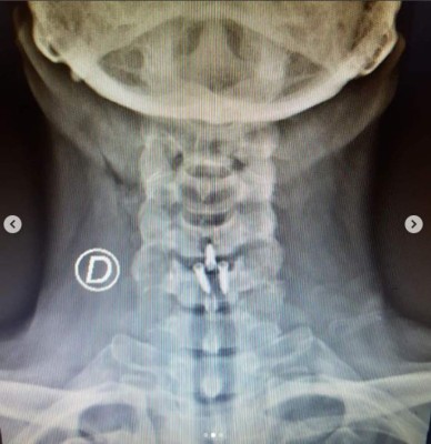 ¿Por qué fue operado de emergencia Arath de la Torre?