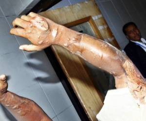 El sufrimiento de este paciente no se esconde, las llagas en sus manos evidencian la razón de sus gritos de dolor. (Fotos: Mario Urrutia)