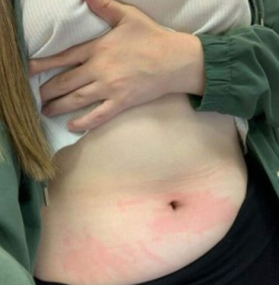 Tessa Hansen-Smith, la mujer alérgica al agua, a sus lágrimas y su sudor