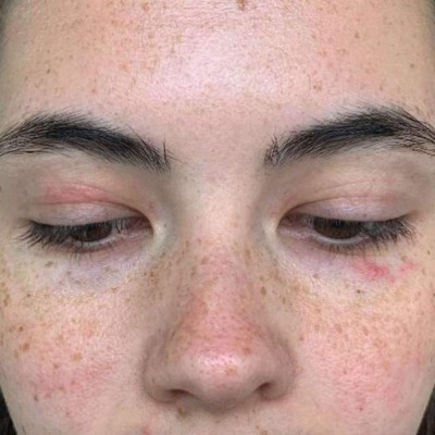 Tessa Hansen-Smith, la mujer alérgica al agua, a sus lágrimas y su sudor