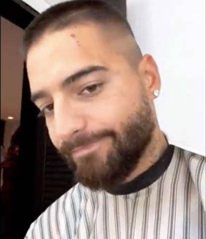 Así luce el rostro del cantante tras ser atacado por su perro Buda.