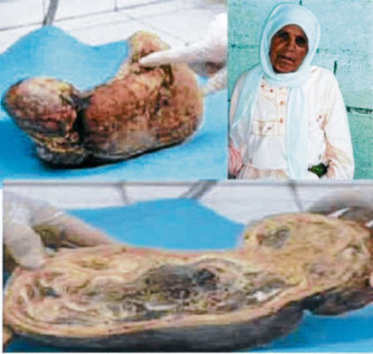 Mujer dio a luz a un bebé petrificado luego de estar 46 años embarazada