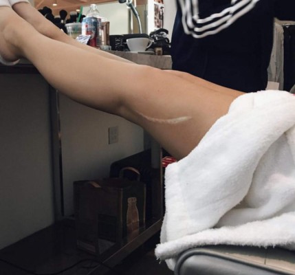 La gran cicatriz de Kylie Jenner