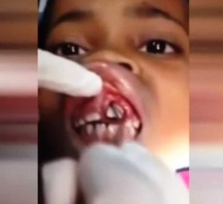 Extraen gusanos de las encías de una niña
