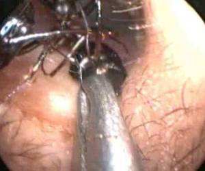 El video de la extracción de los insectos fue compartido por diferentes medios hasta llegar a las redes sociales donde las imágenes se hicieron virales.