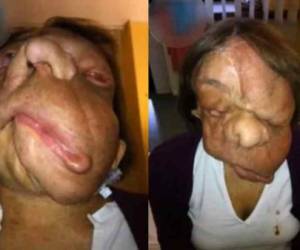 La neurofibromatosis, una condición genética que provoca tumores benignos, le había desfigurado completamente su cara.