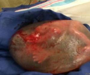 El extraño caso del bebé que nació dentro del saco amniótico.