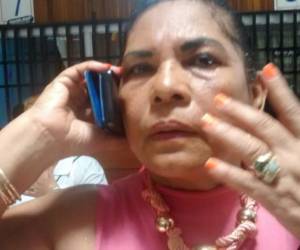 La congresista María Emérita Bardales evidencia inflamación en el área de uno de sus ojos.