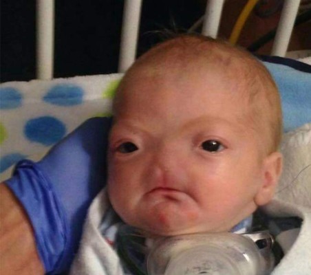 Eli, el bebé sin nariz