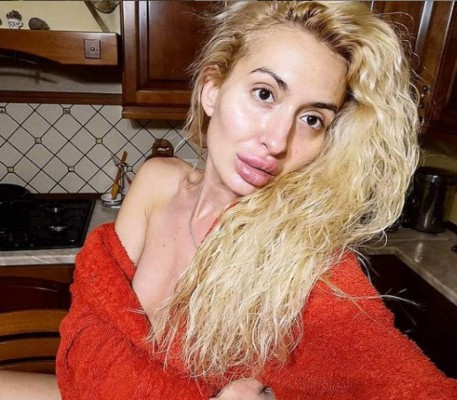 Anastasia Pokreshchuk, la mujer con los pómulos más grandes del mundo (FOTOS)