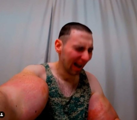 El antes y después del 'Popeye' que se inyectó aceite en los músculos