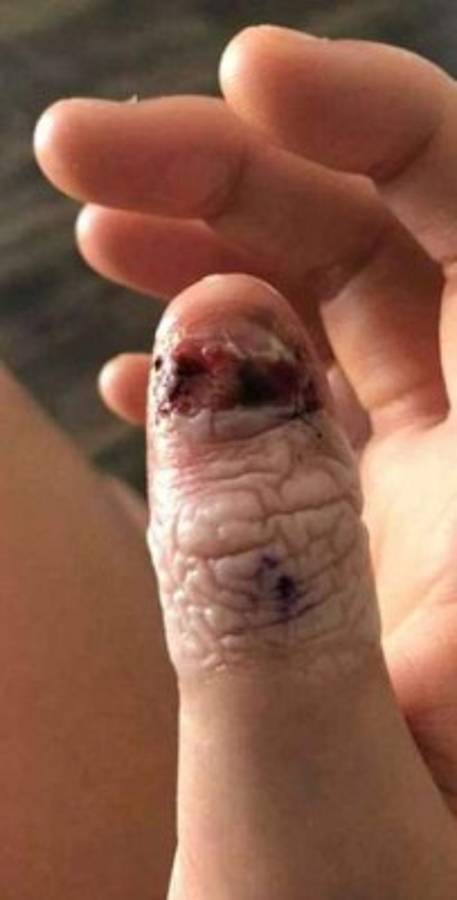 Así quedó el pulgar de la paciente debido al melanoma subungueal lentiginoso acral, un extraño tipo de cáncer de piel. (Captura / Daily Mail)