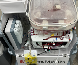 Una máquina de perfusión bombea sangre o un líquido oxigenado a los vasos sanguíneos de un órgano donado.