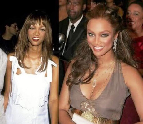 El antes y después de las bubis de las famosas