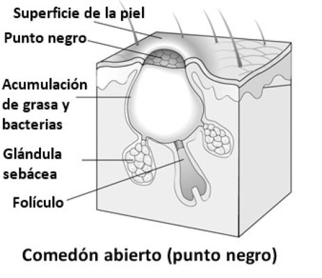 ¿Cómo eliminar los puntos negros de la nariz?