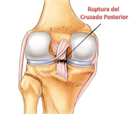 Olimpia: David Meza se niega a la operación