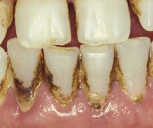 El sarro en los dientes es producto de la higiene bucal. Toma los consejos y evita que estas desagradables manchas desaparezcan.