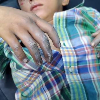 Se desconoce cómo fue que ocurrió el incidente y que tipo de pirotecnia habría sido el que manipuló el pequeño que lo llevó a sufrir quemaduras