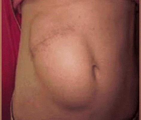 La historia de la mujer que tenía cinco mil piedras en su vesícula