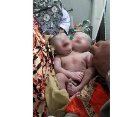 Nace una niña con dos cabezas en Bangladesh