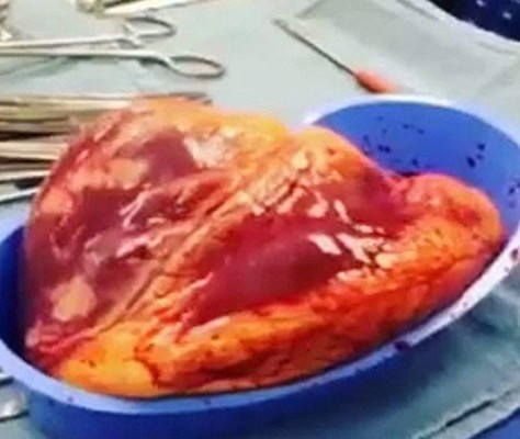 Corazón late fuera del cuerpo