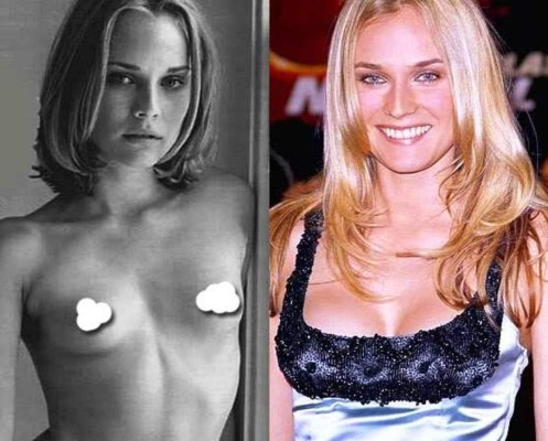 El antes y después de las bubis de las famosas