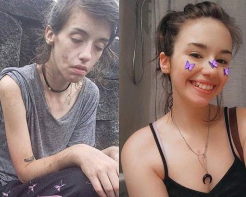 Increíble transformación de Amber Hoffman, joven adicta a las drogas