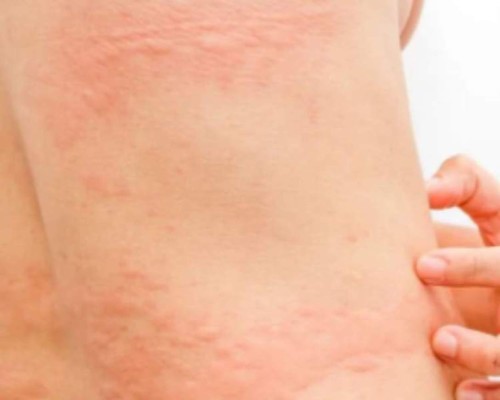 Herpes zóster, otro efecto secundario de vacunas anticovid de Pfizer, Moderna y AstraZeneca&nbsp;&nbsp;