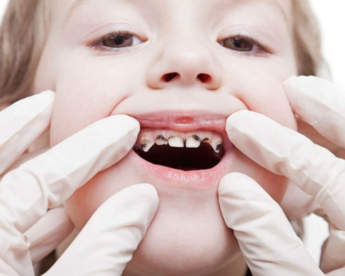 Es indispensable fomentar una buena higiene bucal desde temprana edad. Foto: hospitaldenens