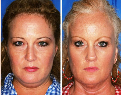 Gemelo no fumador, gemelo fumador: los estragos del cigarrillo