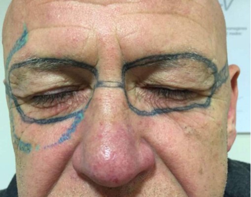 Le tatúan unos 'Ray-Ban' en la cara durante una borrachera