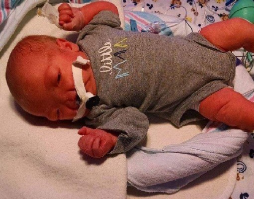 Eli, el bebé sin nariz