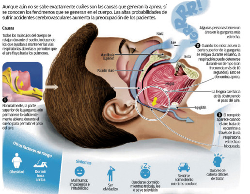 Ronquidos son causal de divorcios y enfermedad