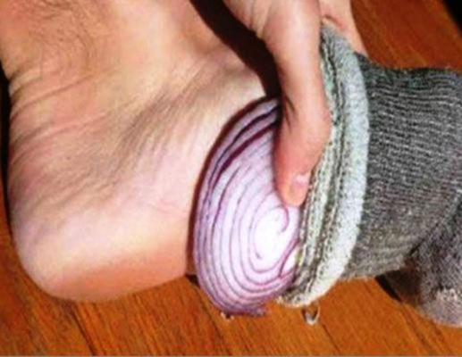 Cebolla en los pies