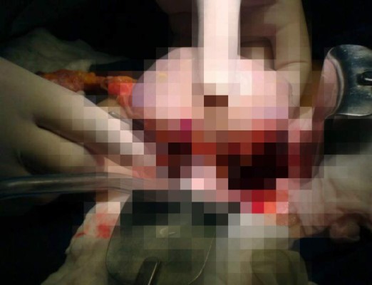 Médicos del HEU realizan con éxito trasplante de riñon a tres niñas hondureñas