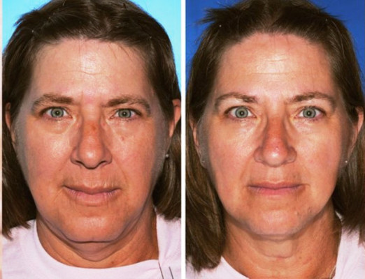 Gemelo no fumador, gemelo fumador: los estragos del cigarrillo