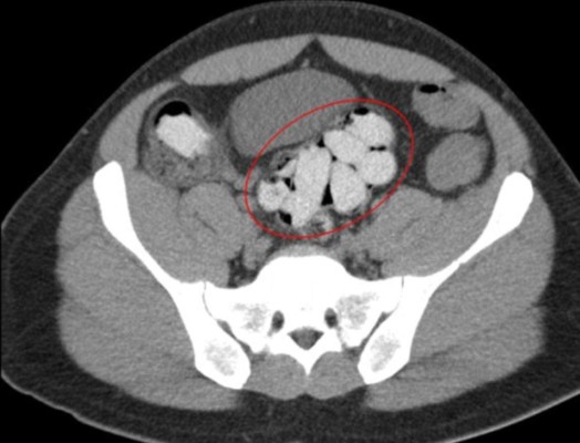 Tres mujeres que traficaban cocaína en el estómago mueren en Venezuela