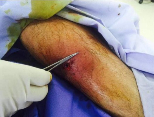 Operan por gangrena a cantante Alejandro Fernández