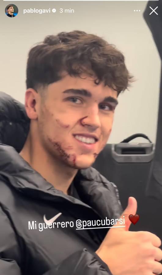 Fuertes imágenes: así quedó la cara de Pau Cubarsí tras recibir patada en Champions League Fuertes imágenes: así quedó la cara de Pau Cubarsí tras recibir patada en Champions League