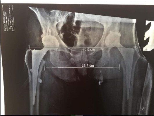 Alejandra Guzmán sigue llevando sus glúteos al quirófano