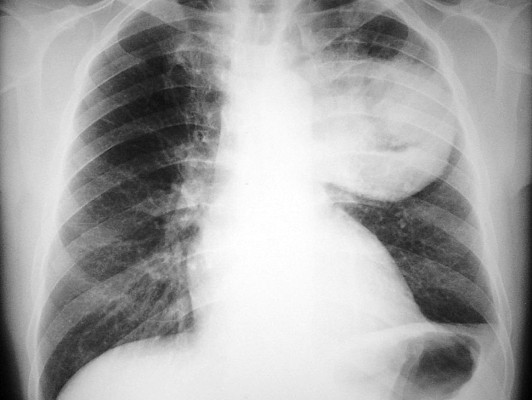 Lo que podría aumentar riesgo de cáncer de pulmón