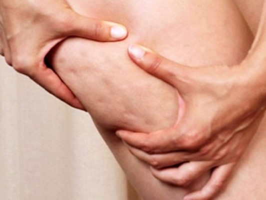 Consejos para combatir la celulitis